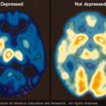 Antidepressivi: Impariamo a Conoscerli